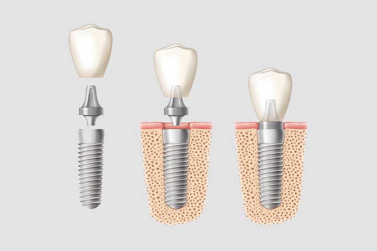 9 Conditions That Require Dental Implant