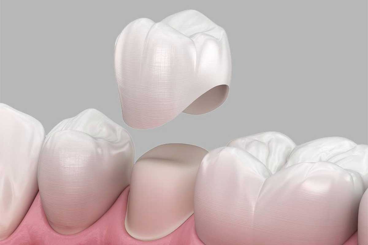 Most Commonly Asked Questions About Dental Crowns